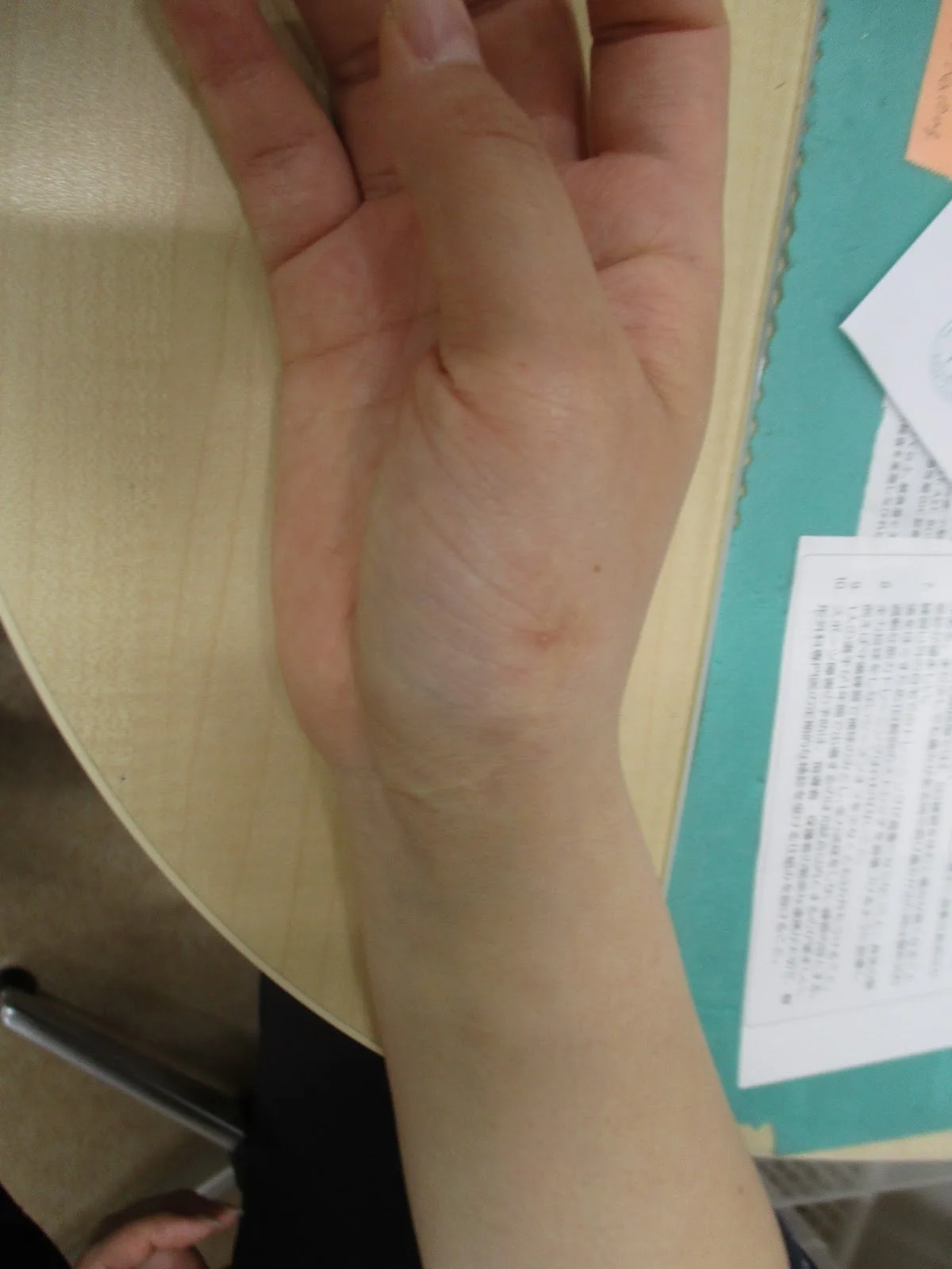 手首の付け根が痛い　　～母指CM関節靭帯損傷～