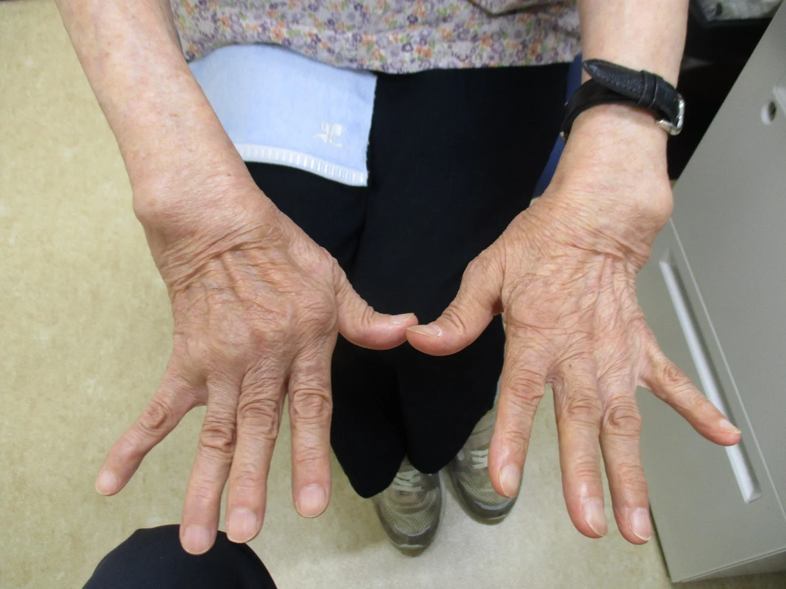 関節リウマチや指変形に対する人工指関節置換術の術後
