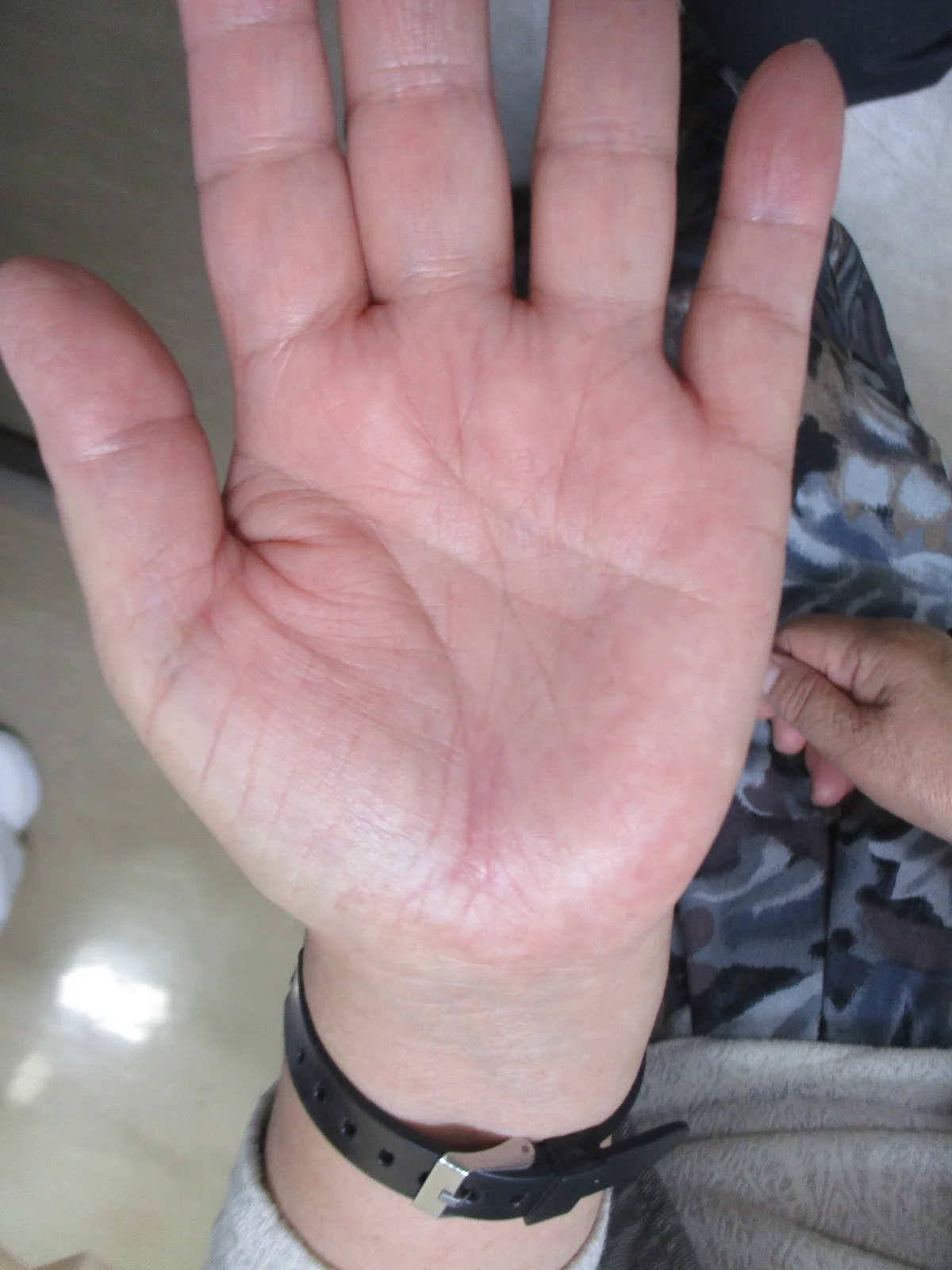 今日の患者さんから ~手根管症候群の手術後の傷~
