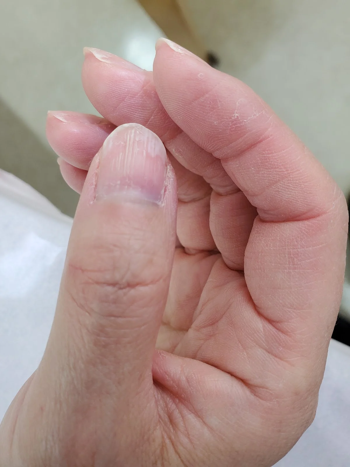ちょっと珍しい爪下の腫瘍(グロームス腫瘍)