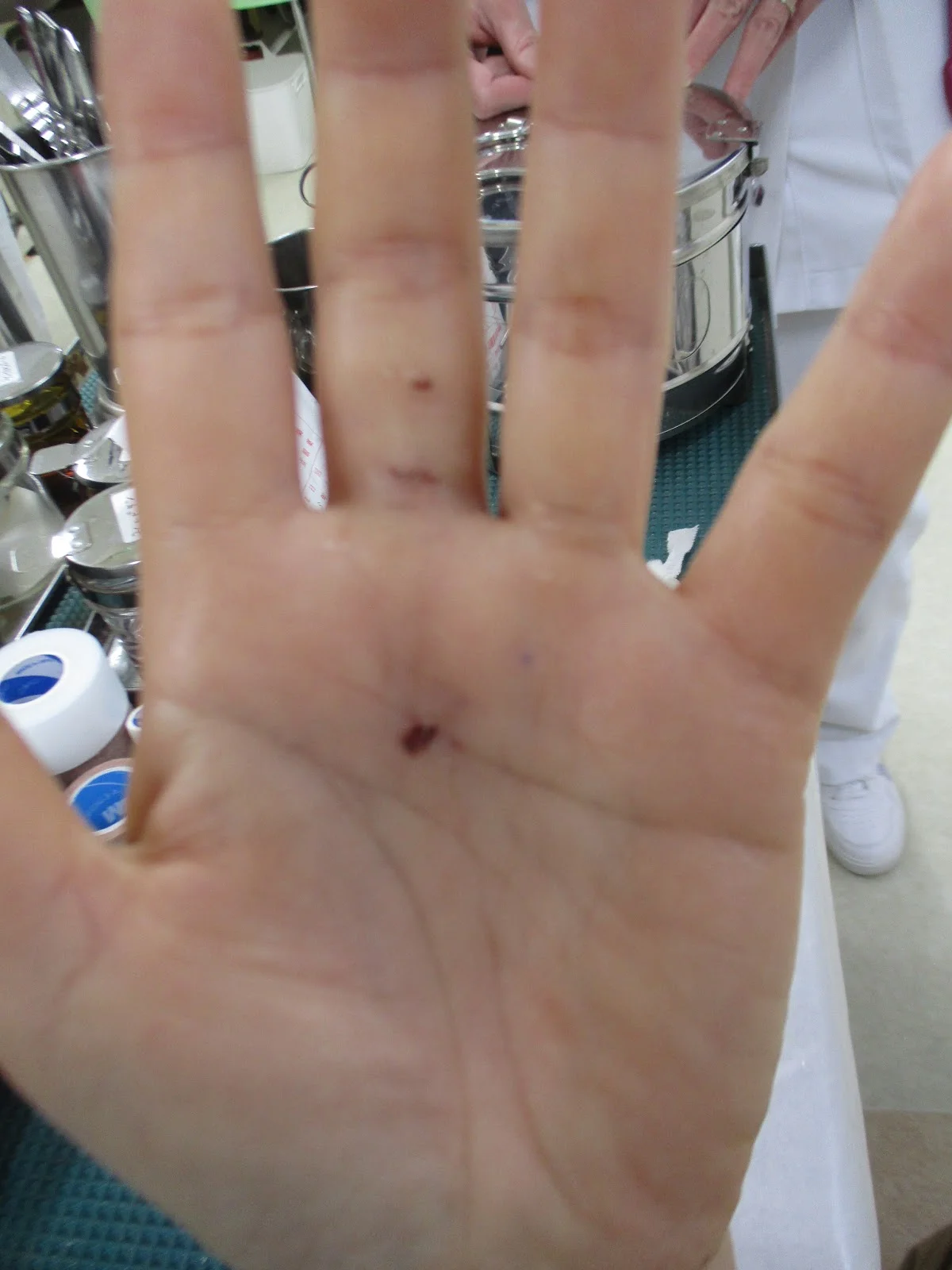 今日の症例から ~ ばね指の関節鏡下腱鞘切開術 ~