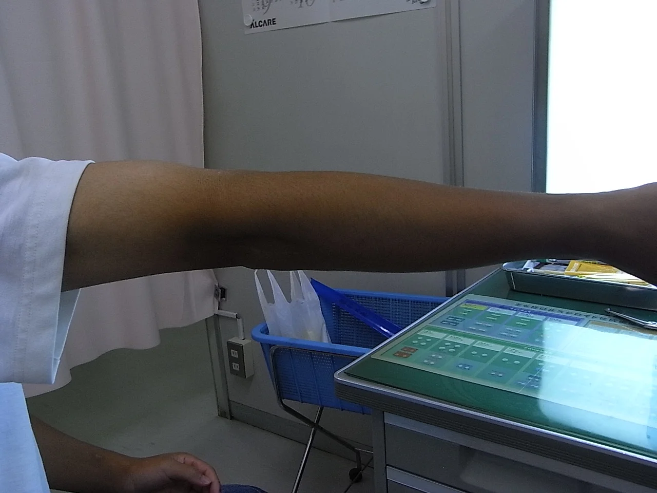 野球肘（外側型：離断性骨軟骨炎）の実際症例